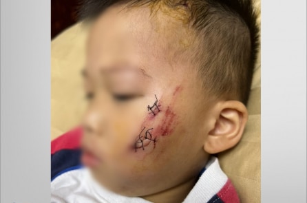Chó nhà nuôi nghi dại cắn rách má bé trai 2 tuổi ở TP. Biên Hòa