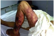 Nhiễm liên cầu khuẩn lợn, nam bệnh nhân nhập viện trong tình trạng nguy kịch