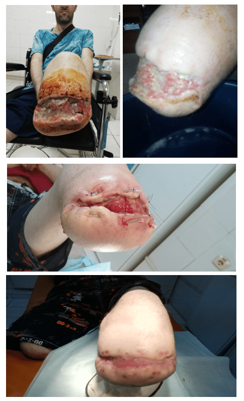 Vet hoai tu do tieu duong hoi phuc nho kem sinh hoc