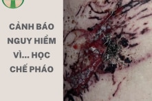 Tự chế pháo nổ, trẻ 14 tuổi bị nát bàn tay, bỏng mắt