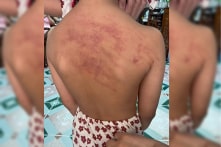 Bé 5 tuổi bị lằn tím lưng: 3 cô giáo phụ trách lớp không biết lý do