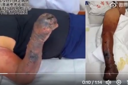 Trung Quốc: Sau Sơn Đông, bệnh than lại xuất hiện ở Hà Bắc