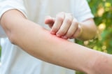 Phương pháp tự nhiên giúp giảm khó chịu do ngứa