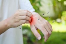 Bác sĩ khuyên: Đừng làm điều này sau khi bị muỗi đốt