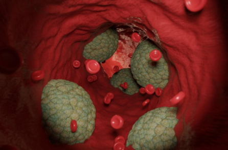 Khi ngủ, hãy thận trọng với 4 dấu hiệu cảnh báo tình trạng tăng mỡ máu