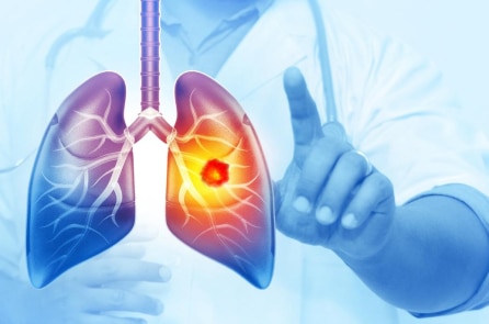 Dư thừa đường trong cơ thể thúc đẩy ung thư phổi tiến triển