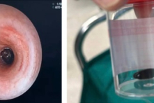 Bác sĩ kịp cứu em bé 13 tháng tuổi hóc hạt mãng cầu suốt 20 ngày