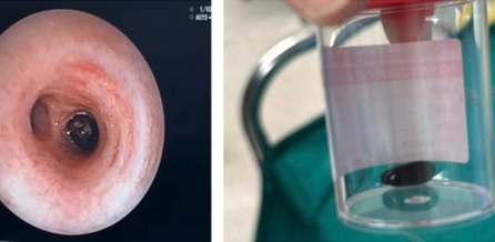 Bác sĩ kịp cứu em bé 13 tháng tuổi hóc hạt mãng cầu suốt 20 ngày