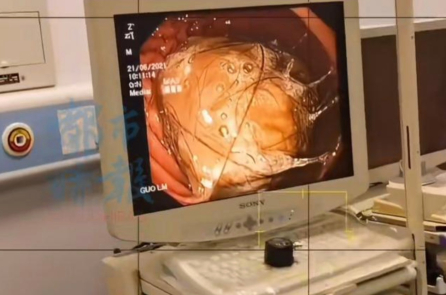 TQ: Bé gái ăn tóc trong thời gian dài, bác sĩ lấy ra 2 chậu tóc trong dạ dày