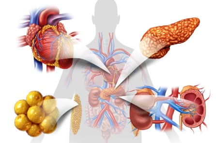 Hội chứng phổ biến làm tăng nguy cơ tim mạch và suy thận nhưng ít người biết tới