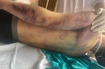 Một học viên trung tâm công tác xã hội bị đánh đến chết não