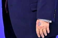 Ông Trump: Vết bầm trên mu bàn tay tại Davos vì aspirin liều cao, va tay vào bàn