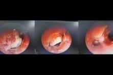 Hạt hạnh nhân mắc kẹt 7 ngày trong phế quản thiếu niên 15 tuổi 