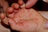 Diễn biến bệnh tay chân miệng tại phía Nam: Ghi nhận 8 ca tử vong