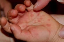 Diễn biến bệnh tay chân miệng tại phía Nam: Ghi nhận 8 ca tử vong