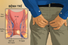 Nghiên cứu mới tiết lộ các phương pháp điều trị bệnh trĩ hiệu quả nhất
