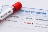 Tăng axit uric: Khi nào đáng lo và có phải luôn cần uống thuốc?