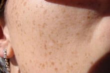 Mối quan hệ bất ngờ giữa sức khỏe đường ruột và đốm đồi mồi