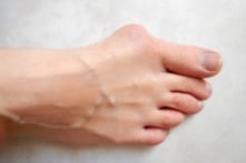 Vẹo ngón chân cái có nguy hiểm không? 3 bài tập giúp cải thiện