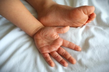 Tay chân miệng gia tăng trước năm học mới: Cha mẹ cần chú ý những gì?
