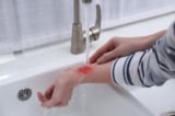 Vì sao không nên dùng nước lạnh như đá để rửa vết bỏng?
